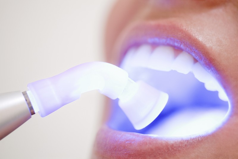 Tooth Bonding - Oral Health Center-Dental Care Westerville
